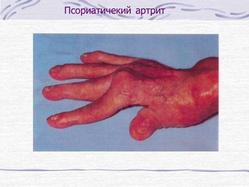 Псориаз:   - псориатические высыпания на коже   - псориаз ногтевых пластинок